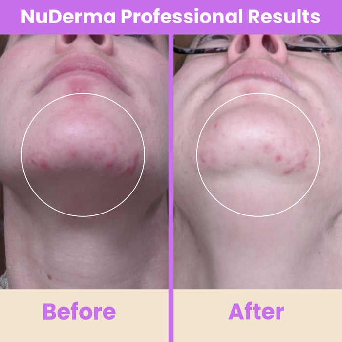 NuDerma professional  before and after results