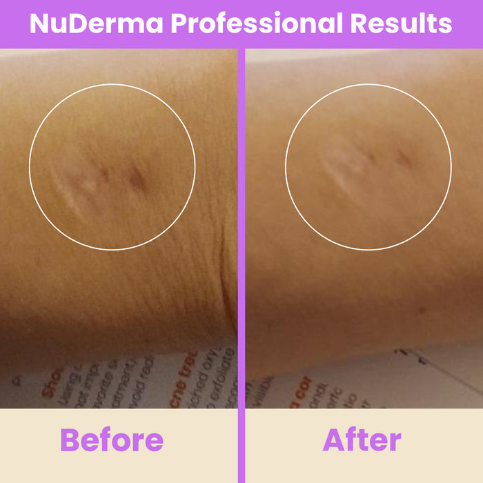 NuDerma professional  before and after
